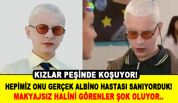 Hepimiz onu Albino hastası biliyorduk!